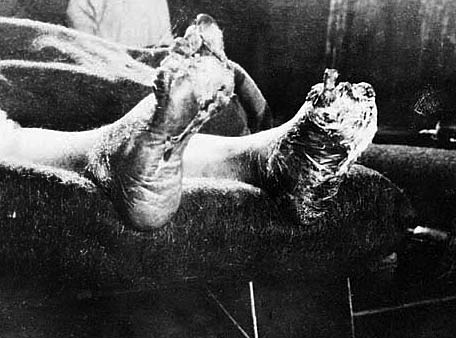 Gangrene, trench feet